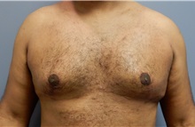 Male Breast Reduction After Photo by Emily Pollard, MD; Philadelphia, PA - Case 37576