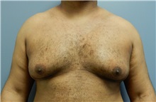 Male Breast Reduction Before Photo by Emily Pollard, MD; Philadelphia, PA - Case 37576