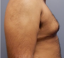 Male Breast Reduction After Photo by Emily Pollard, MD; Philadelphia, PA - Case 37576