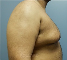 Male Breast Reduction Before Photo by Emily Pollard, MD; Philadelphia, PA - Case 37576