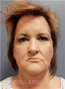 Facelift Before Photo by Emily Pollard, MD; Ardmore, PA - Case 37934