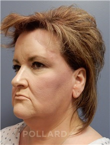 Facelift Before Photo by Emily Pollard, MD; Ardmore, PA - Case 37934