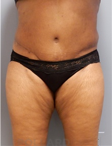 Tummy Tuck After Photo by Emily Pollard, MD; Philadelphia, PA - Case 40642