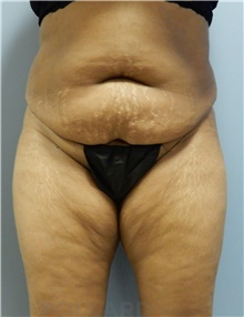 Tummy Tuck Before Photo by Emily Pollard, MD; Philadelphia, PA - Case 40642