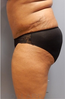 Tummy Tuck After Photo by Emily Pollard, MD; Philadelphia, PA - Case 40642