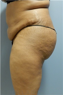 Tummy Tuck Before Photo by Emily Pollard, MD; Philadelphia, PA - Case 40642