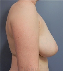 Breast Lift Before Photo by Emily Pollard, MD; Philadelphia, PA - Case 40645