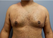Male Breast Reduction After Photo by Emily Pollard, MD; Bala Cynwyd, PA - Case 40647