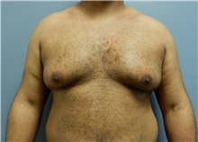 Male Breast Reduction Before Photo by Emily Pollard, MD; Bala Cynwyd, PA - Case 40647