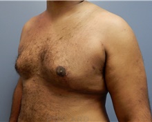 Male Breast Reduction After Photo by Emily Pollard, MD; Philadelphia, PA - Case 40647
