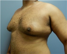 Male Breast Reduction Before Photo by Emily Pollard, MD; Philadelphia, PA - Case 40647