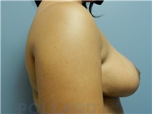 Breast Lift After Photo by Emily Pollard, MD; Ardmore, PA - Case 42548
