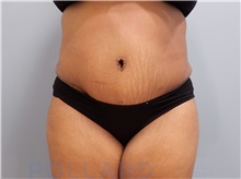 Tummy Tuck After Photo by Emily Pollard, MD; Ardmore, PA - Case 42551