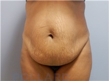 Tummy Tuck Before Photo by Emily Pollard, MD; Ardmore, PA - Case 42551