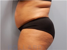 Tummy Tuck After Photo by Emily Pollard, MD; Ardmore, PA - Case 42551