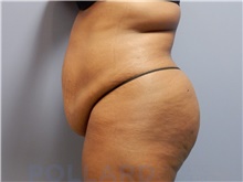 Tummy Tuck Before Photo by Emily Pollard, MD; Ardmore, PA - Case 42551