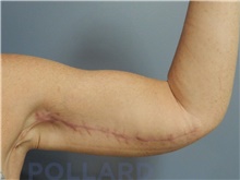Arm Lift After Photo by Emily Pollard, MD; Bala Cynwyd, PA - Case 43771