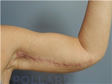 Arm Lift After Photo by Emily Pollard, MD; Ardmore, PA - Case 43771