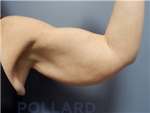 Arm Lift Before Photo by Emily Pollard, MD; Bala Cynwyd, PA - Case 43771