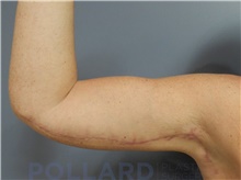 Arm Lift After Photo by Emily Pollard, MD; Ardmore, PA - Case 43771