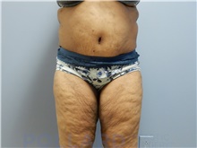 Tummy Tuck After Photo by Emily Pollard, MD; Ardmore, PA - Case 43776