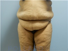 Tummy Tuck Before Photo by Emily Pollard, MD; Ardmore, PA - Case 43776