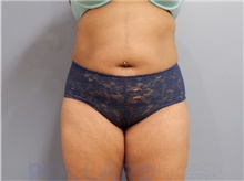 Liposuction After Photo by Emily Pollard, MD; Bala Cynwyd, PA - Case 43777