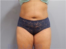 Liposuction After Photo by Emily Pollard, MD; Ardmore, PA - Case 43777