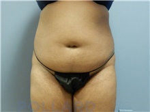 Liposuction Before Photo by Emily Pollard, MD; Bala Cynwyd, PA - Case 43777