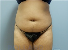 Liposuction Before Photo by Emily Pollard, MD; Ardmore, PA - Case 43777