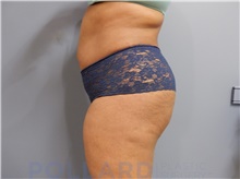 Liposuction After Photo by Emily Pollard, MD; Ardmore, PA - Case 43777