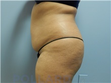 Liposuction Before Photo by Emily Pollard, MD; Ardmore, PA - Case 43777