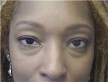 Eyelid Surgery Before Photo by Emily Pollard, MD; Bala Cynwyd, PA - Case 7267