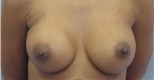 Breast Augmentation After Photo by Emily Pollard, MD; Ardmore, PA - Case 7268