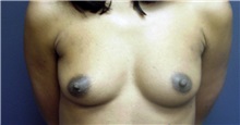 Breast Augmentation Before Photo by Emily Pollard, MD; Ardmore, PA - Case 7268