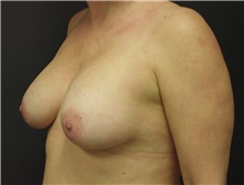 Breast Augmentation After Photo by Emily Pollard, MD; Ardmore, PA - Case 8027