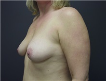 Breast Augmentation Before Photo by Emily Pollard, MD; Ardmore, PA - Case 8027