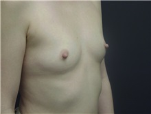 Breast Augmentation Before Photo by Emily Pollard, MD; Ardmore, PA - Case 8028
