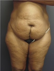 Tummy Tuck Before Photo by Emily Pollard, MD; Ardmore, PA - Case 8708