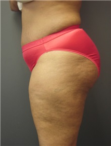 Tummy Tuck After Photo by Emily Pollard, MD; Ardmore, PA - Case 8708