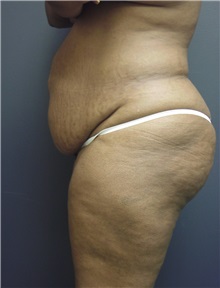 Tummy Tuck Before Photo by Emily Pollard, MD; Ardmore, PA - Case 8708