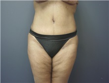 Tummy Tuck After Photo by Emily Pollard, MD; Ardmore, PA - Case 8712