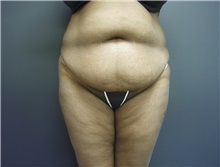 Tummy Tuck Before Photo by Emily Pollard, MD; Ardmore, PA - Case 8712
