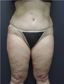 Tummy Tuck After Photo by Emily Pollard, MD; Ardmore, PA - Case 8713