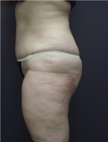 Tummy Tuck After Photo by Emily Pollard, MD; Ardmore, PA - Case 8713