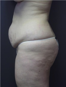 Tummy Tuck Before Photo by Emily Pollard, MD; Ardmore, PA - Case 8713