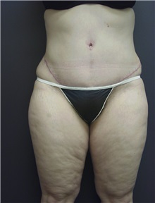 Tummy Tuck After Photo by Emily Pollard, MD; Ardmore, PA - Case 9707
