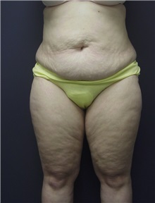 Tummy Tuck Before Photo by Emily Pollard, MD; Ardmore, PA - Case 9707