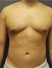 Liposuction After Photo by Emily Pollard, MD; Ardmore, PA - Case 9709