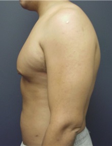 Liposuction After Photo by Emily Pollard, MD; Ardmore, PA - Case 9709